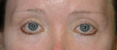 Revision Blepharoplasty - Patient 3 - Before